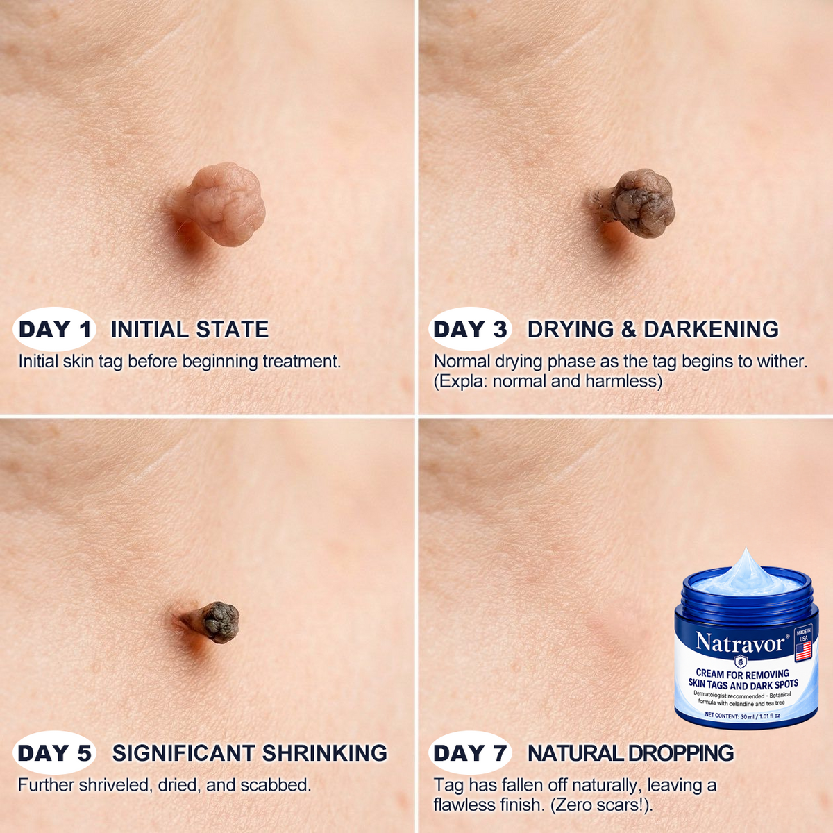 Natravor® 7-𝐃𝐚𝐲 𝐒𝐤𝐢𝐧 𝐓𝐚𝐠 & 𝐒𝐩𝐨𝐭 𝐄𝐫𝐚𝐬𝐞𝐫 𝐂𝐫𝐞𝐚𝐦 , Moles & Spots – 7‑Day Painless & Scar‑Free – Advanced Care for Skin Imperfections 💎