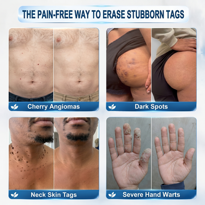 Natravor® 7-𝐃𝐚𝐲 𝐒𝐤𝐢𝐧 𝐓𝐚𝐠 & 𝐒𝐩𝐨𝐭 𝐄𝐫𝐚𝐬𝐞𝐫 𝐂𝐫𝐞𝐚𝐦 , Moles & Spots – 7‑Day Painless & Scar‑Free – Advanced Care for Skin Imperfections 💎